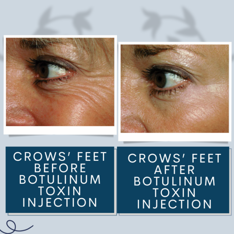 Botulinum Toxin Injections Eye Physicians Of Northampton