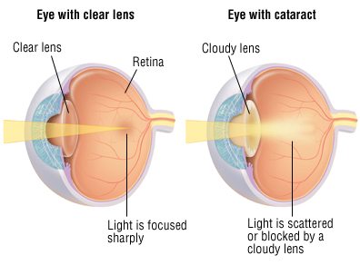 cataract